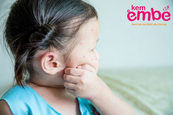 Bé khó chịu khi bị côn trùng cắn