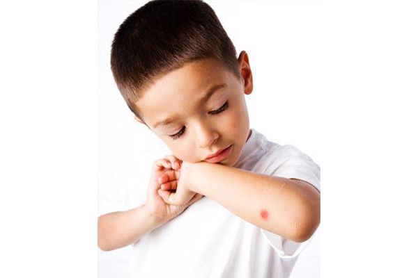 bé bị muỗi đốt
