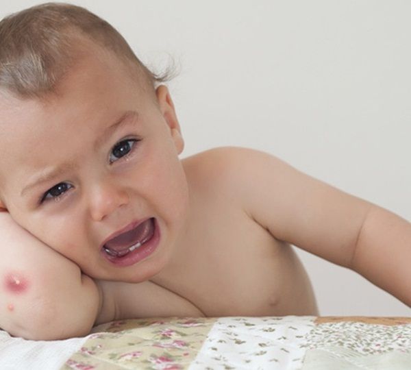 côn trùng đốt sưng đỏ