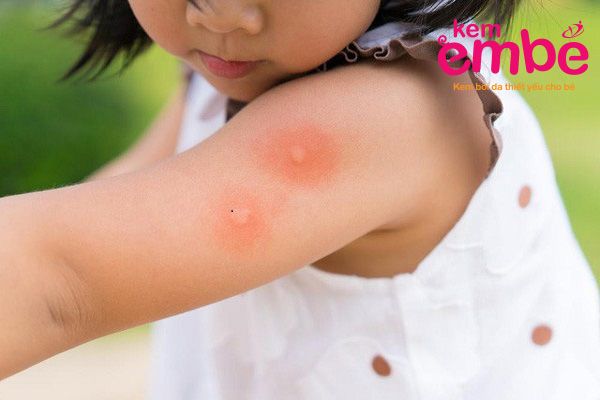 Triệu chứng bé bị muỗi đốt