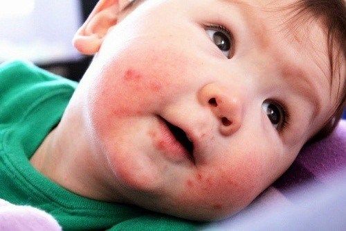 trẻ bị côn trùng đốt