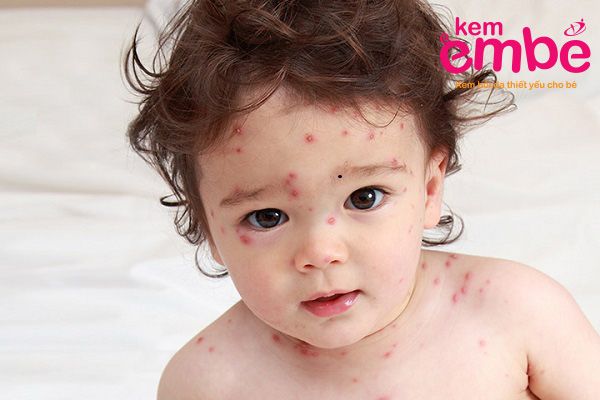 Triệu chứng bé bị dị ứng như muỗi đốt