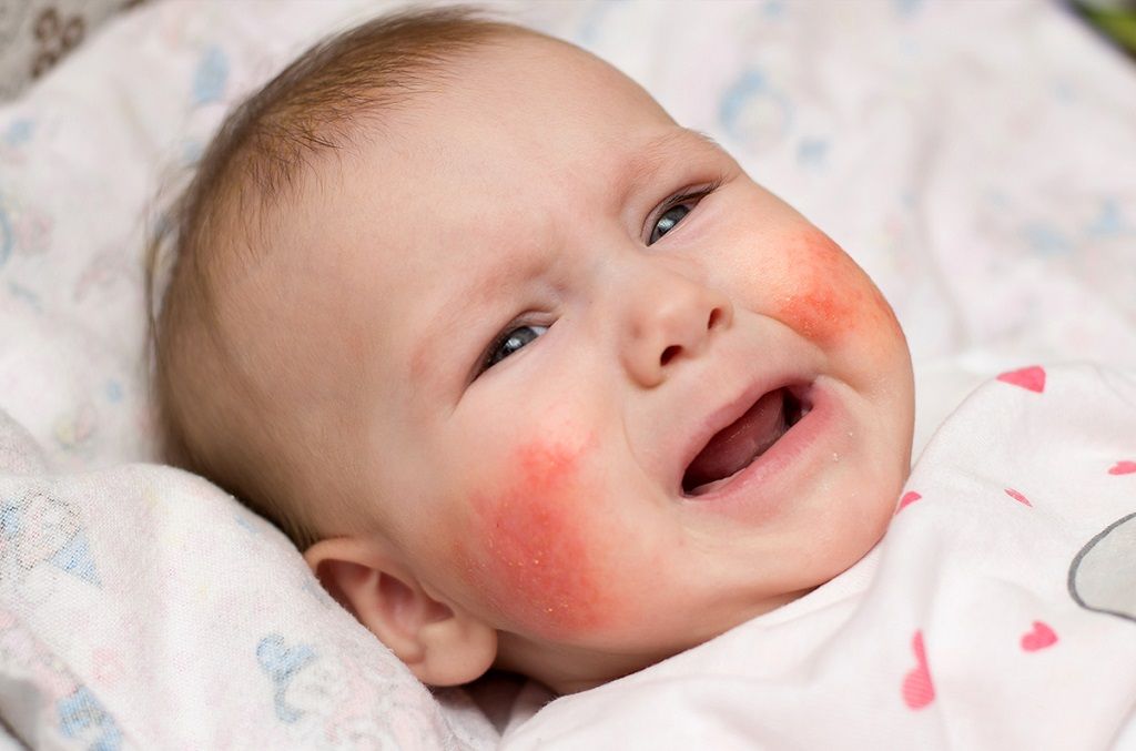 bệnh viêm da cơ địa ở trẻ em