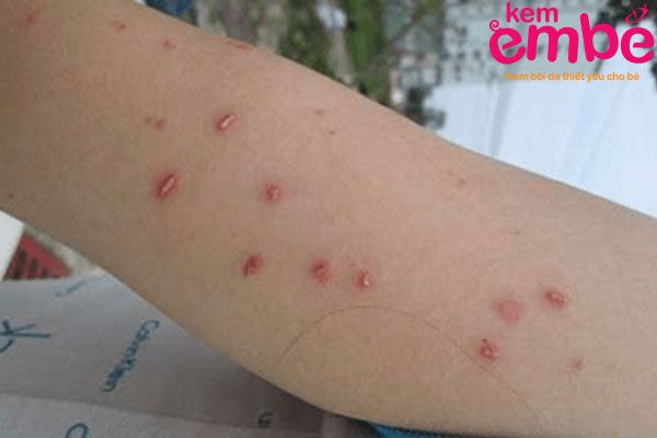 Dấu hiệu bị côn trùng cắn mưng mủ