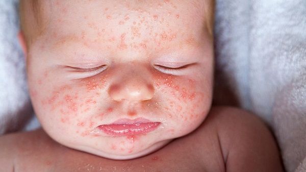 mặt nổi mụn như rôm