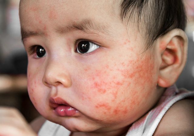 da mặt bé bị khô sần