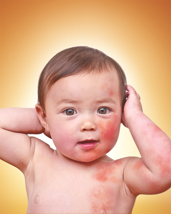 bé bị chàm sữa