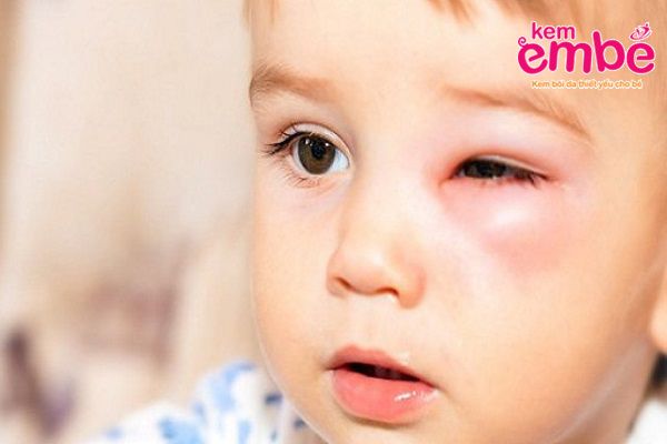 Triệu chứng trẻ bị côn trùng cắn sưng mắt