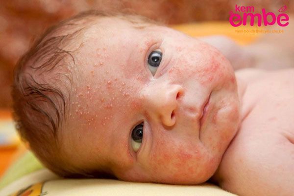 Trẻ sơ sinh bị rôm sảy mủ