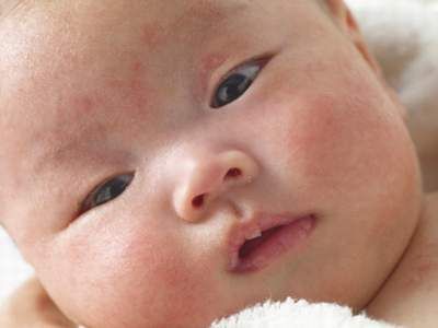 bé bị khô da mặt