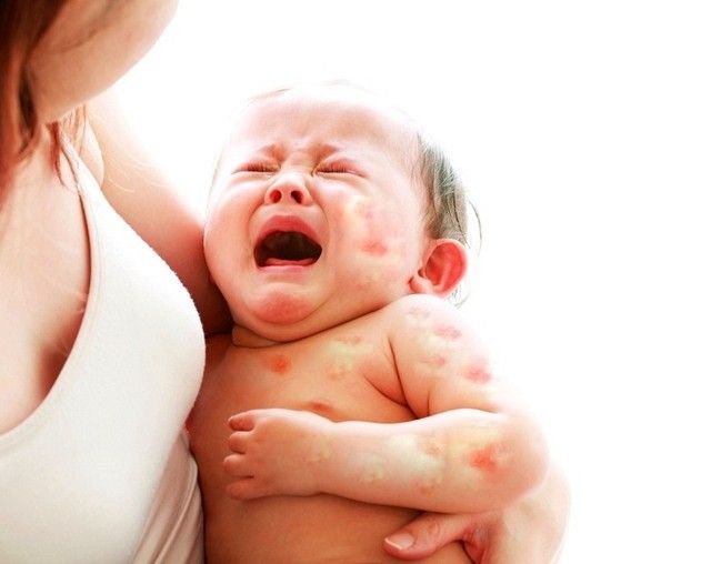 bé nổi mẩn đỏ