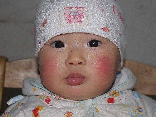 em bé bị nẻ má