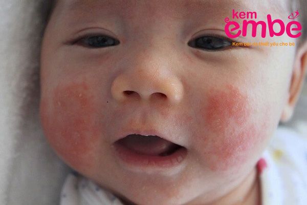 Chàm sữa ở trẻ do nhiều nguyên nhân gây ra