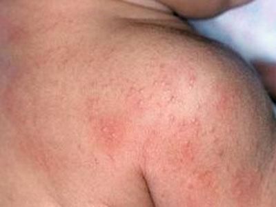 trị rôm sảy cho bé