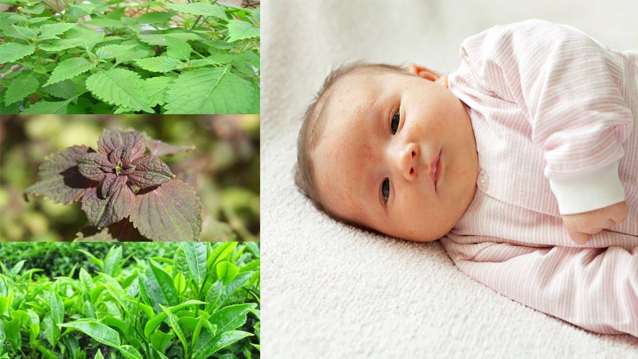 trị rôm sảy cho trẻ