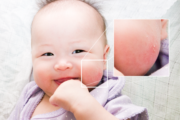 chàm sữa ở trẻ nhỏ
