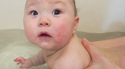 viêm da cơ địa ở trẻ em