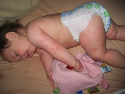 bé bị nổi mẩn đỏ
