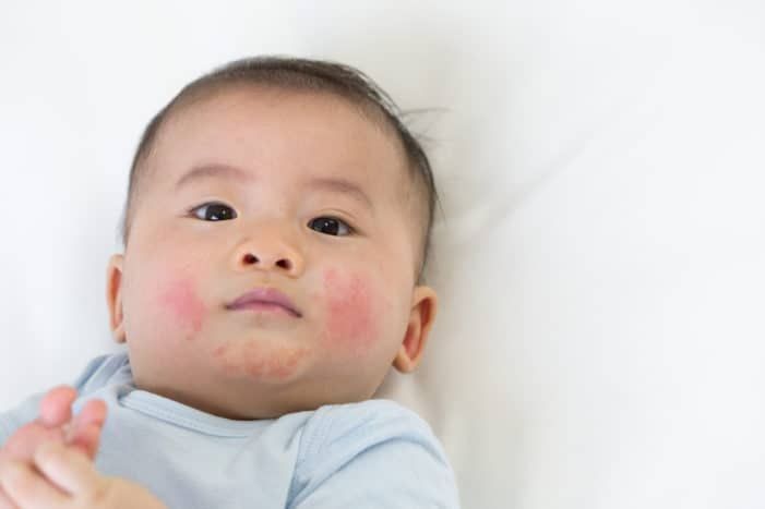 trẻ sơ sinh bị nẻ