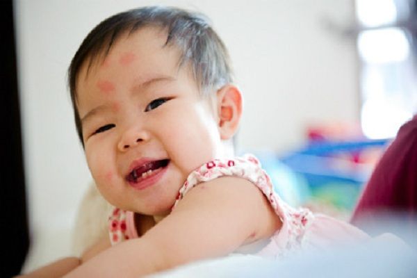 côn trùng đốt bé