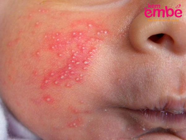 Hình ảnh rôm sảy trẻ sơ sinh dạng rôm sảy mủ