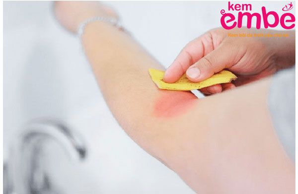 Bé bị muỗi đốt sưng to bôi gì nhanh khỏi