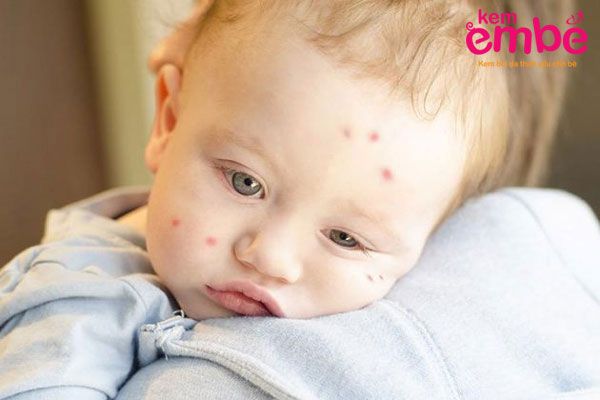 Triệu chứng khi trẻ sơ sinh bị muỗi đốt mưng mủ