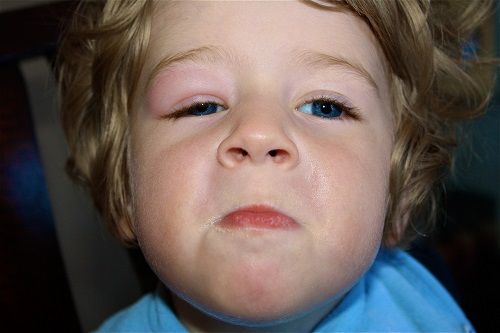 côn trùng đốt sưng tấy