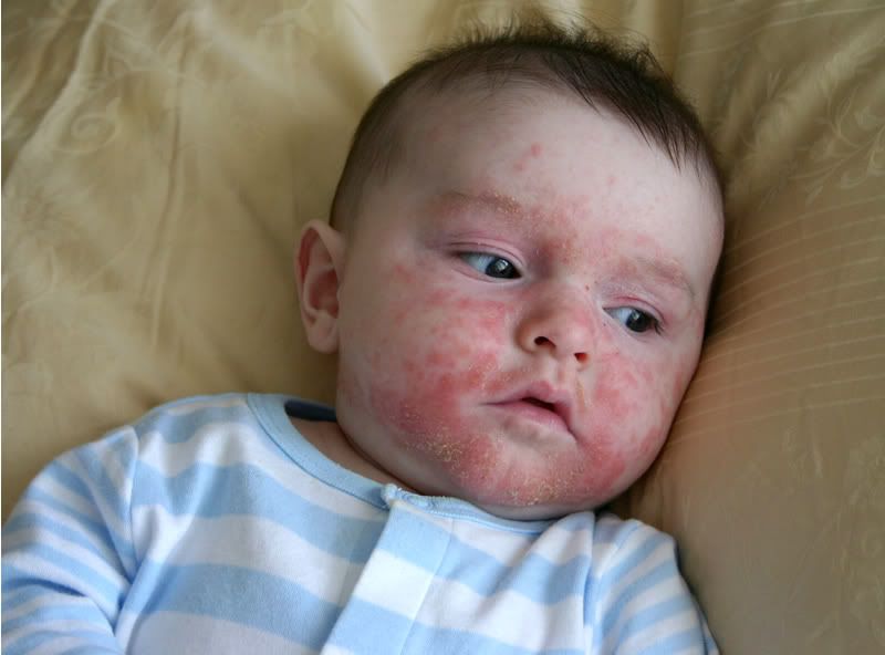 cách trị lác đồng tiền