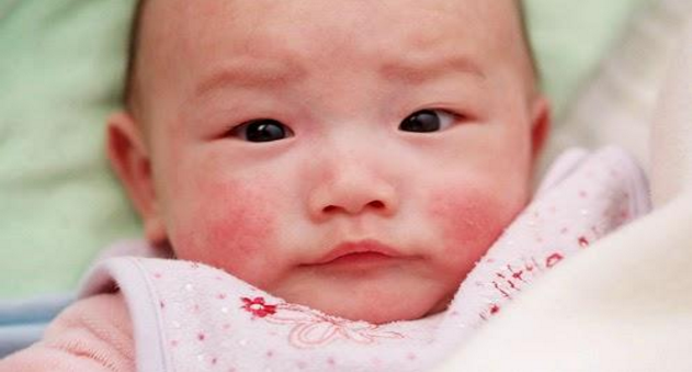 bé bị nẻ da mặt