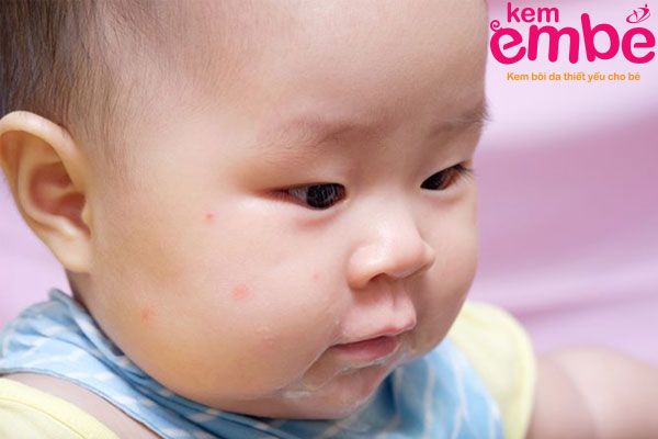 Những lưu ý khi trẻ bị côn trùng cắn sưng môi