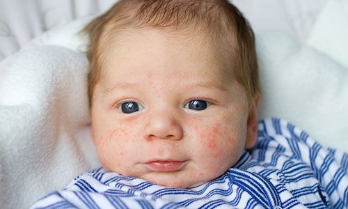 cách trị rôm sảy
