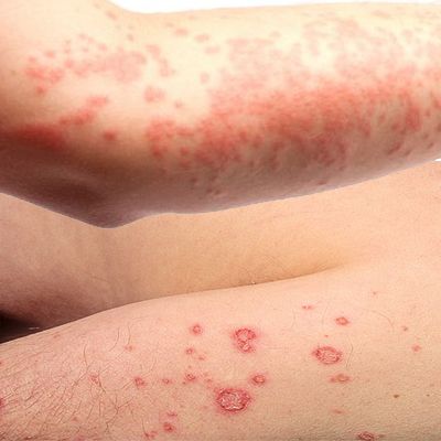 bệnh eczema