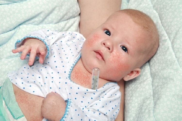 bệnh eczema