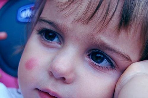 trẻ bị côn trùng đốt