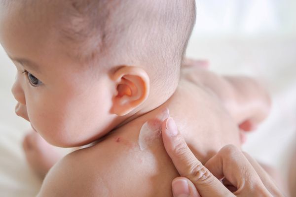 rôm sảy ở lưng bé