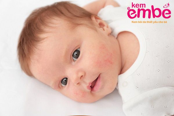 Chàm sữa ở vị trí mặt em bé