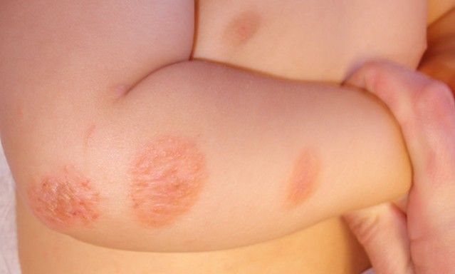 cách trị lác đồng tiền ở bé