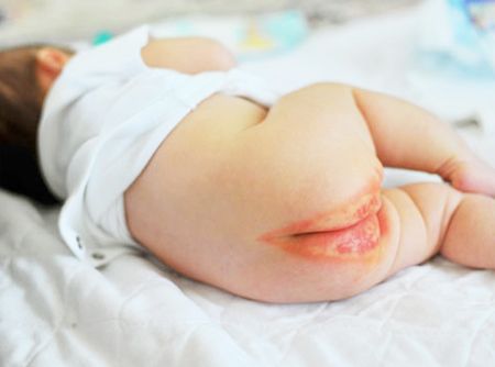 cách chọn kem chống hăm cho bé