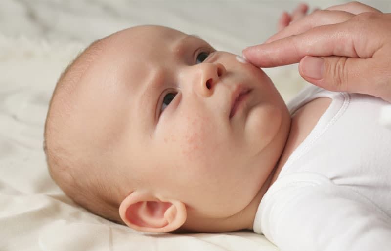 cách trị chàm sữa