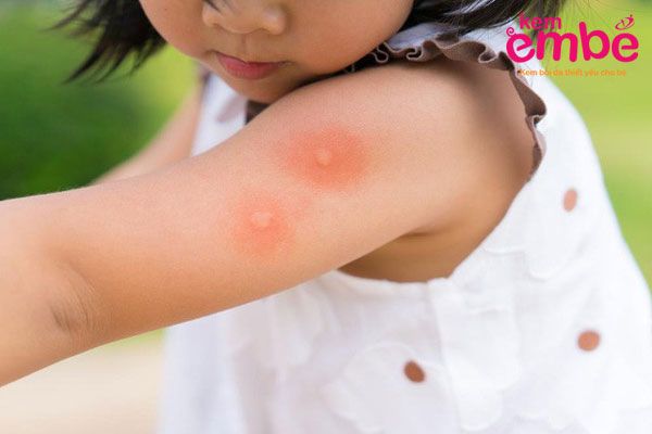 Hình ảnh bé bị muỗi đốt ở tay