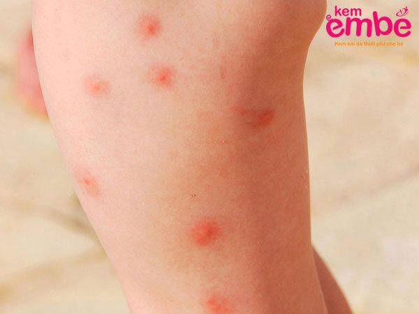 Dấu hiệu khi trẻ bị muỗi đốt sưng mọng nước