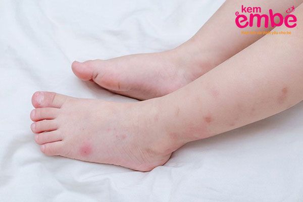Chân bé bị muỗi đốt hãy áp dụng 11 cách sau để điều trị
