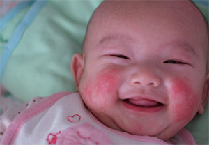 bé sơ sinh bị khô da