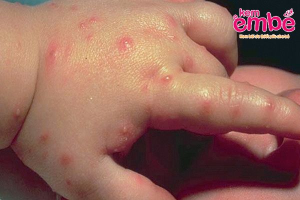 Khi trẻ bị côn trùng cắn phụ huynh không nên chủ quan