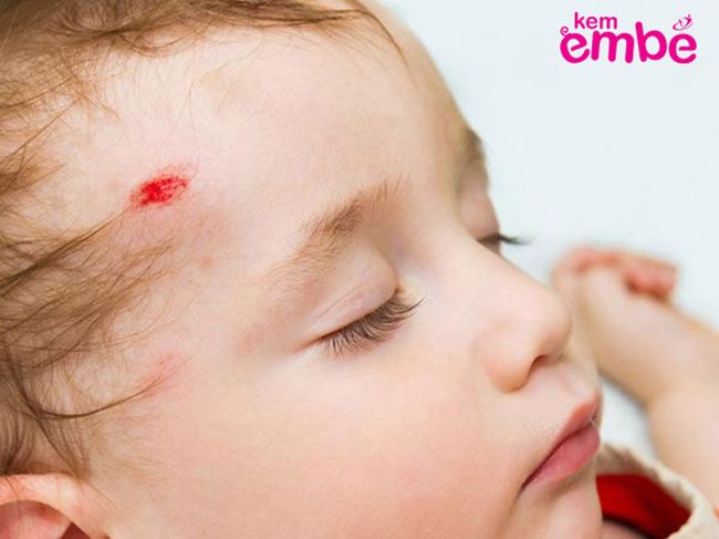 Cách xử lý vết trầy xước tránh nhiễm trùng