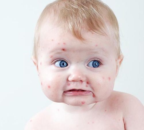 trẻ bị côn trùng đốt