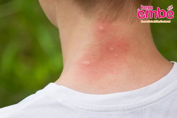 Bị côn trùng cắn ngứa ngáy xuất hiện các vết đỏ sưng to