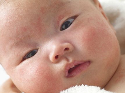 bé bị rôm sảy