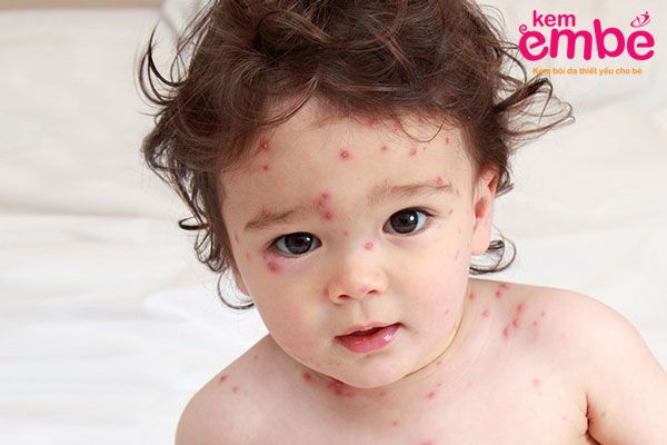 Trẻ bị muỗi đốt sưng cứng
